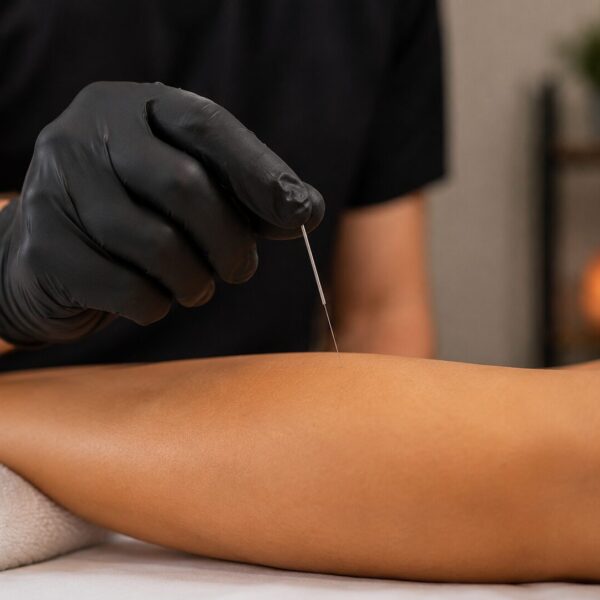 Dry Needling